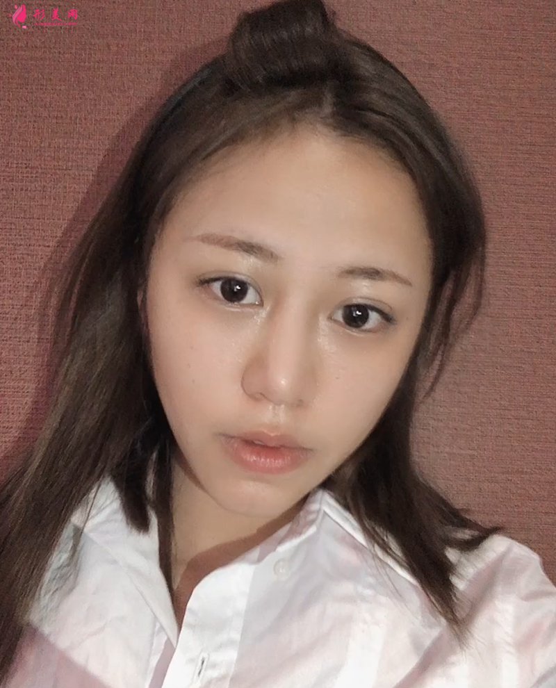 上海自体脂肪面部填充前后对比图