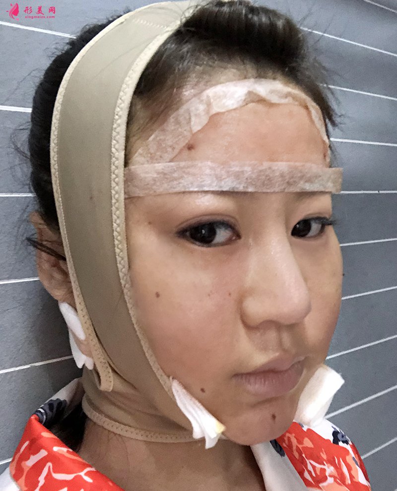 上海自体脂肪面部填充前后对比图