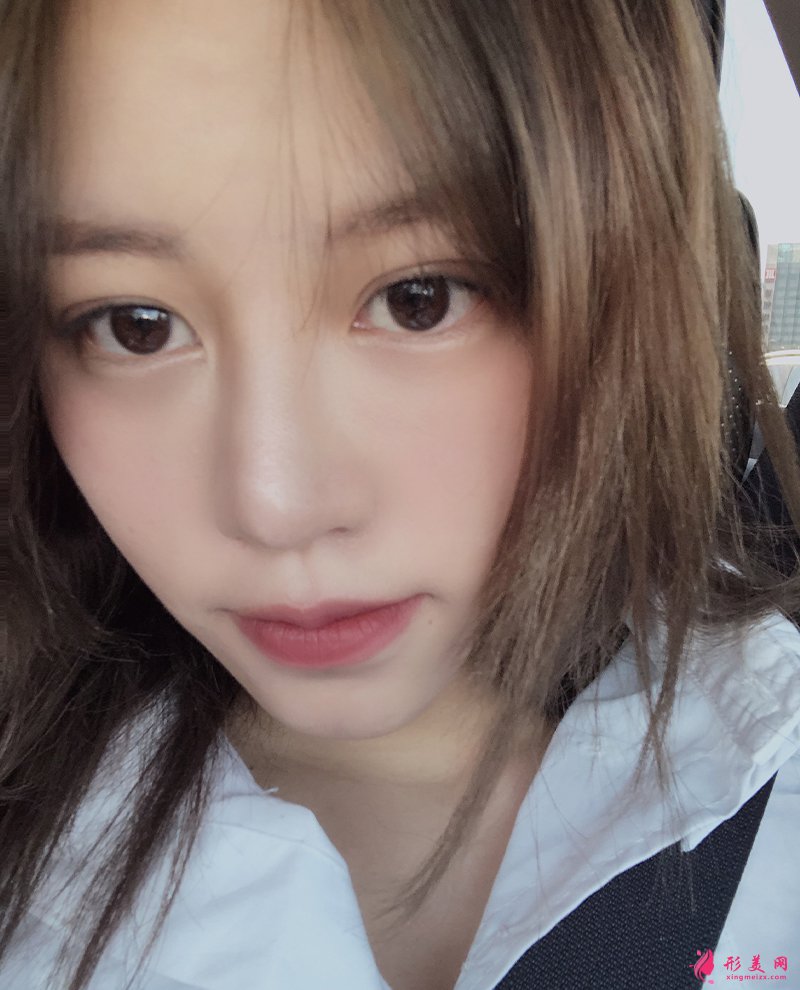 上海自体脂肪面部填充前后对比图