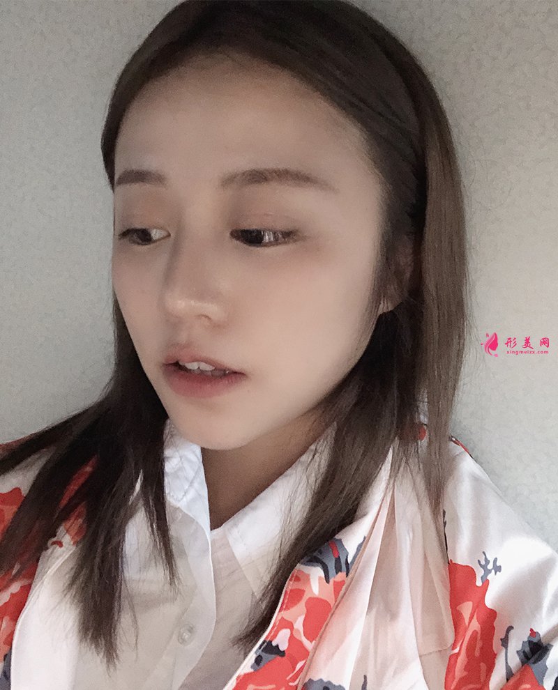 上海自体脂肪面部填充前后对比图