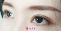 双眼皮手术方法有哪几种呢？