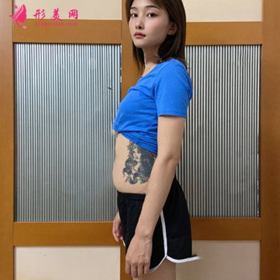 合肥小姐姐腰腹吸脂术后恢复效果展示