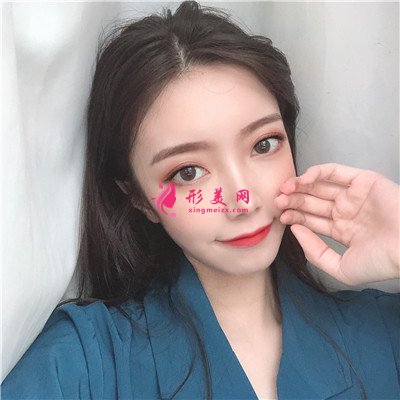 杭州切开双眼皮术后恢复效果反馈 术后 杭州切开双眼皮术后恢复效果反馈