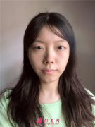 杭州同荣丽格切开双眼皮术后恢复效果反馈