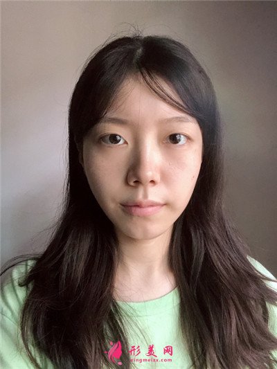 杭州切开双眼皮术后恢复效果反馈