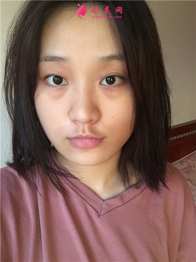 杭州面部埋线提升术后恢复情况对比