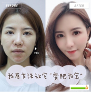 广州广大整形美容医院做的自体脂肪面部填充，价格不到两万