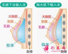 假体隆胸可以哺乳么？