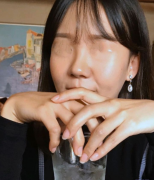 上海九院张路做的肋软骨鼻综合案例分享，这鼻子你喜欢吗