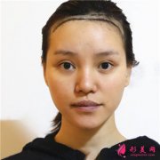 南京碧莲盛小姐姐种植发际线术后效果分享