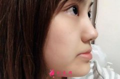 上海九院牙齿矫正效果分享