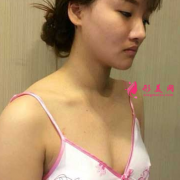 上海华美隆胸的效果如何，看我三个月的效果好不好