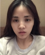 上海九院隆鼻贵不贵？做了鼻综合面部整体立体感出来了