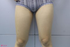 上海伯思立吸脂瘦大腿的详细过程分享~快来看术后效果好不好