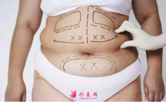腰腹部吸脂要多久恢复好？