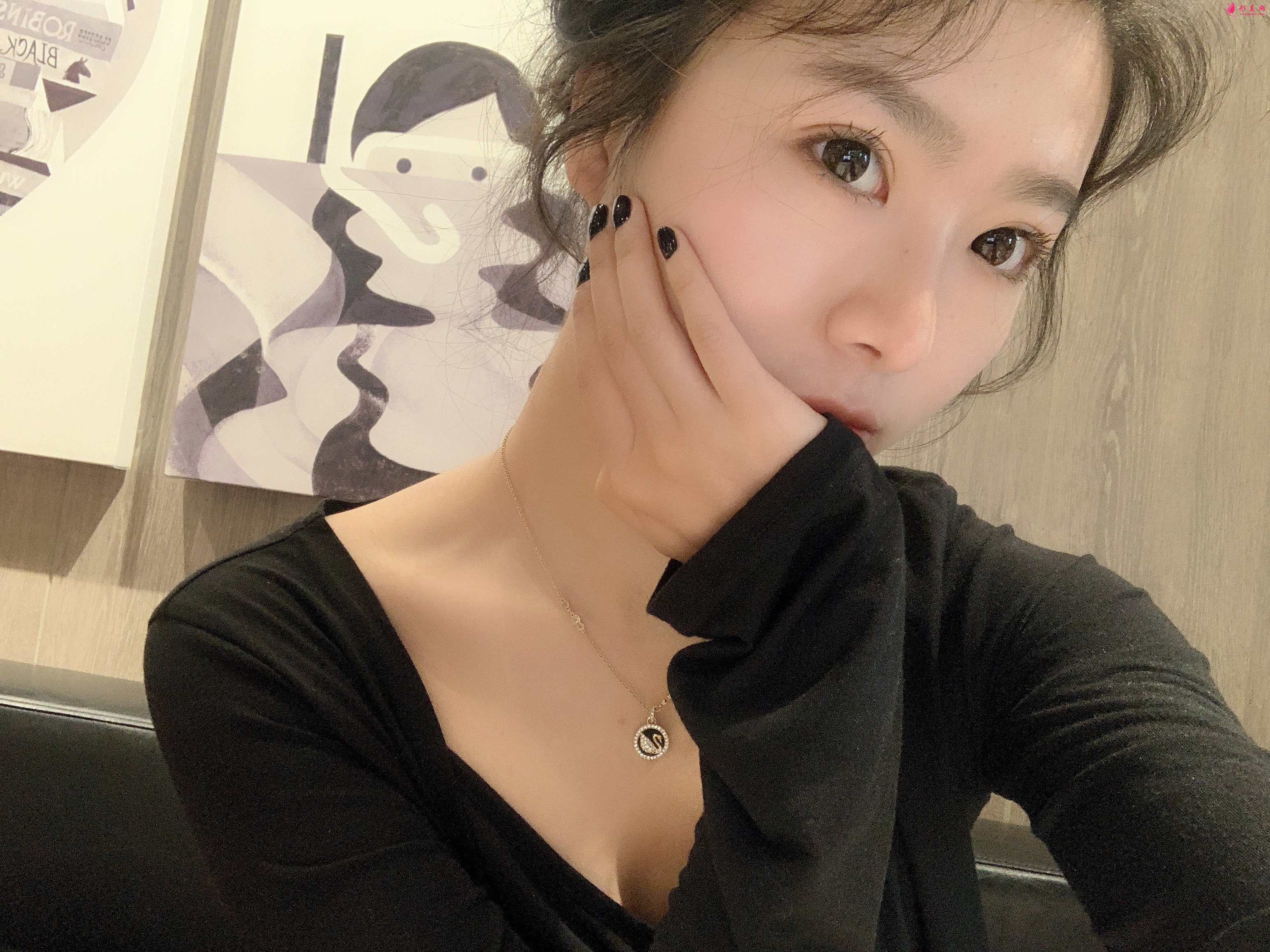 四川友谊医院向朝自体软骨垫鼻基底怎么样？案例57天效果分享