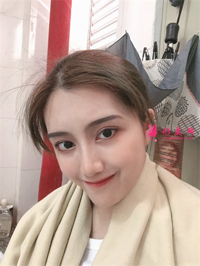 杭州小仙女齐全双眼皮术后恢复情况对比 术后 杭州小仙女齐全双眼皮术后恢复情况对比