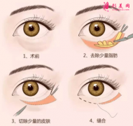 手术祛眼袋的效果怎么样？