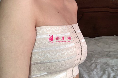 广州假体隆胸效果分享 术后 广州假体隆胸效果分享