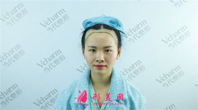 重庆种植发际线手术术后效果反馈