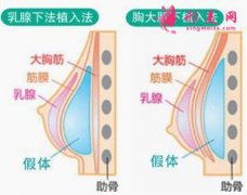 假体隆胸后会痛多长时间？