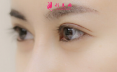 切开双眼皮术后需要住院观察吗？