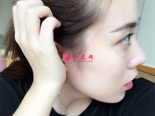 成都打玻尿酸丰面颊手术效果分享