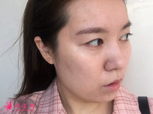 成都打玻尿酸丰面颊手术效果分享