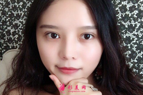 武汉全切双眼皮效果分享