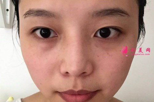 武汉全切双眼皮效果分享