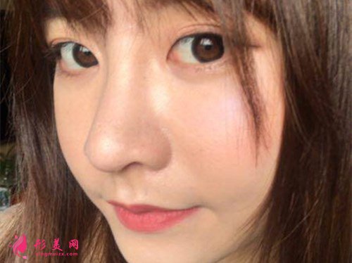 成都肋软骨隆鼻案例效果分享