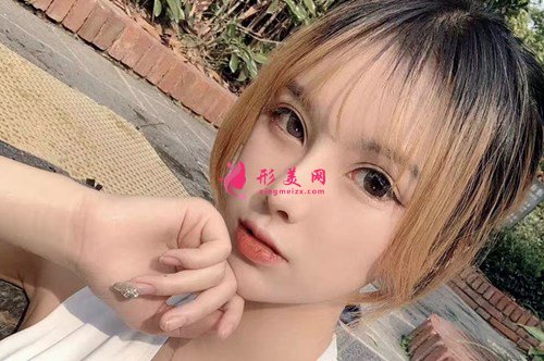 上海颧弓降低手术分享 术后 上海颧弓降低手术分享