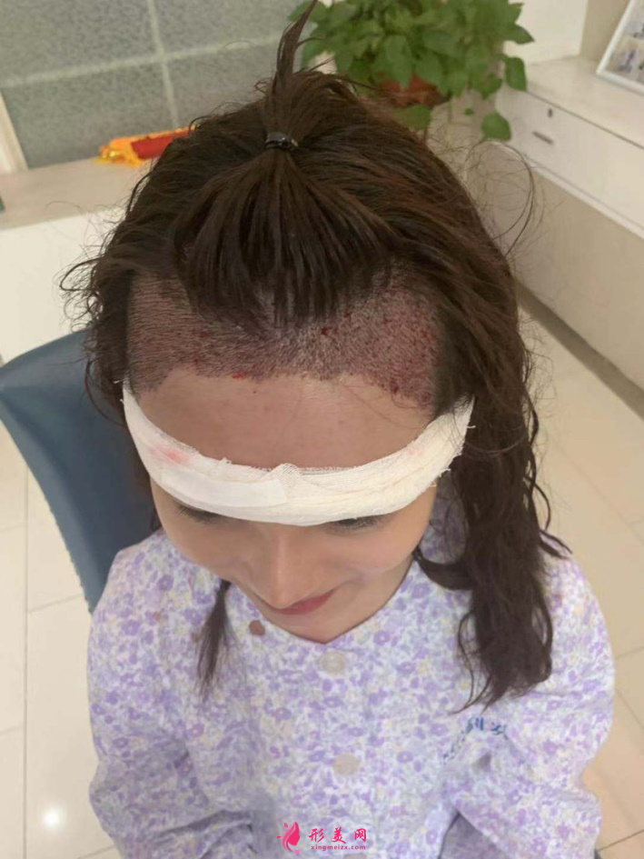 北京植发哪家医院做的比较好？附植发案例+2021价格表