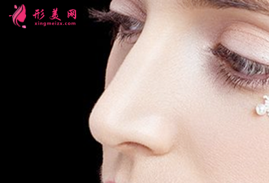 自体软骨隆鼻整形有什么优点