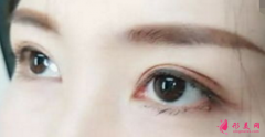 双眼皮手术前要注意的事项