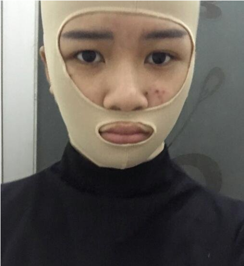 上海九院颧骨内推多少钱？全新价格表来袭！附案例分享