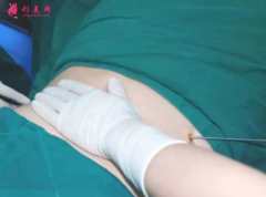 腰腹部吸脂需要住院吗？