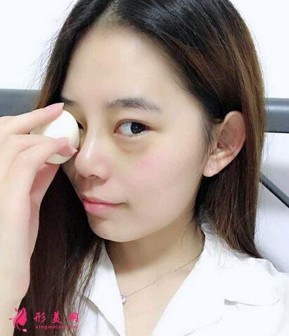眼部整形手术价钱是多少?术后注意事项是什么?
