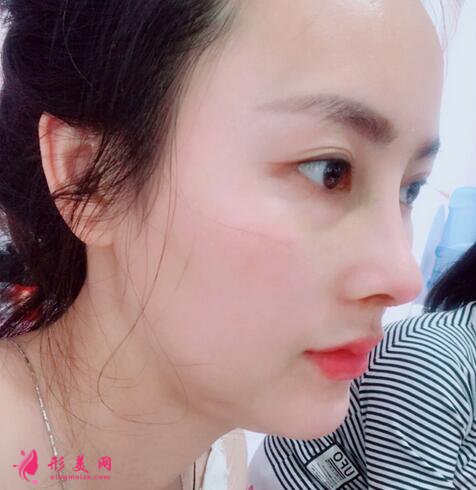 眼部整形手术价钱是多少?术后注意事项是什么?