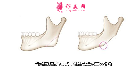 传统下颌角手术 传统下颌角手术