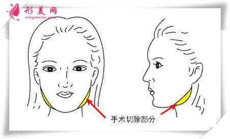 下颌角手术部位 下颌角手术部位