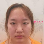 中国医学科院整形外科医院八大处怎么样？附双眼皮手术恢复过程图