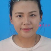 郑州大学第二附属医院怎么样？附双眼皮手术前后对比图一览