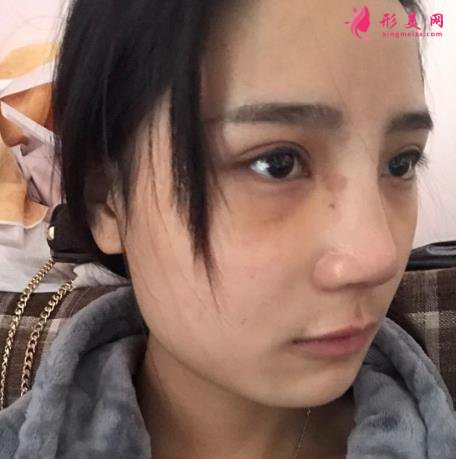 郑州大学第一附属医院整形科怎么样？隆鼻价格及恢复效果展示