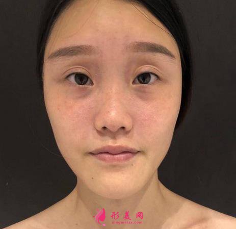 武汉同济医院整形科隆鼻怎么样?附术后案例及价格表一览~