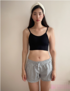 广州紫馨整形外科医院吸脂怎么样？腰腹吸脂前后对比图一览