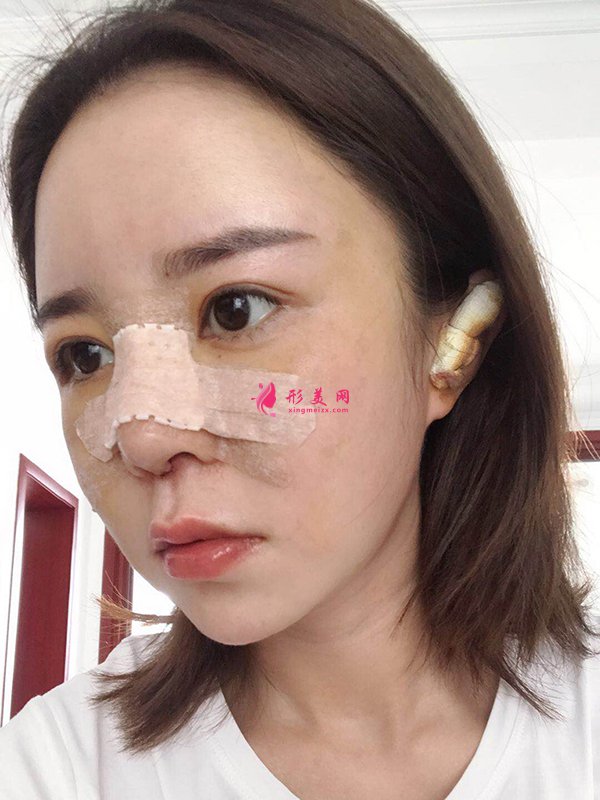 上海华美医疗美容医院徐文龙医生膨体隆鼻案例-整容案例 上海华美医疗美容医院徐文龙医生膨体隆鼻案例