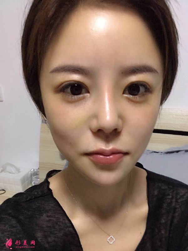 上海华美医疗美容医院徐文龙医生膨体隆鼻案例-整容案例 上海华美医疗美容医院徐文龙医生膨体隆鼻案例