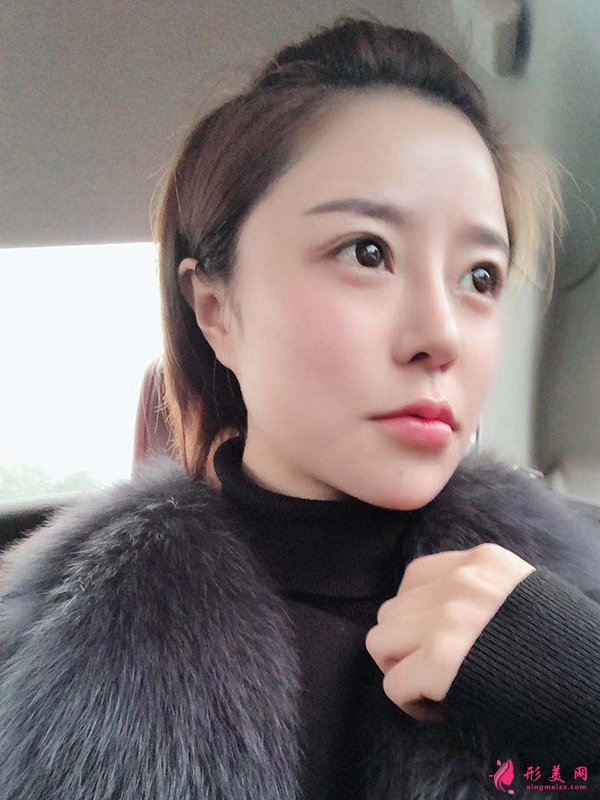 上海华美医疗美容医院徐文龙医生膨体隆鼻案例-整容案例 上海华美医疗美容医院徐文龙医生膨体隆鼻案例