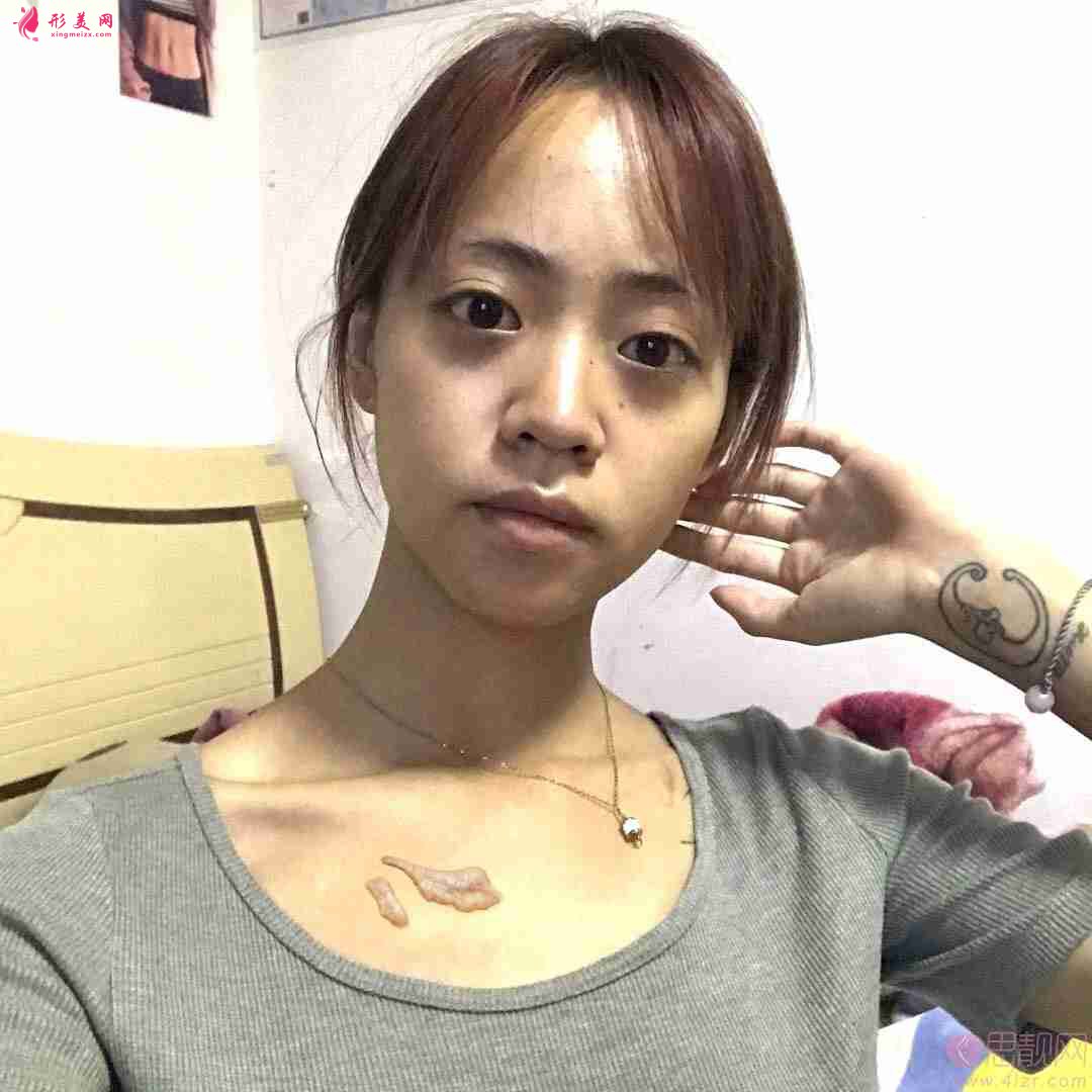 四川友谊整形美容科疤痕修复怎么样?附2020价格表详情一览